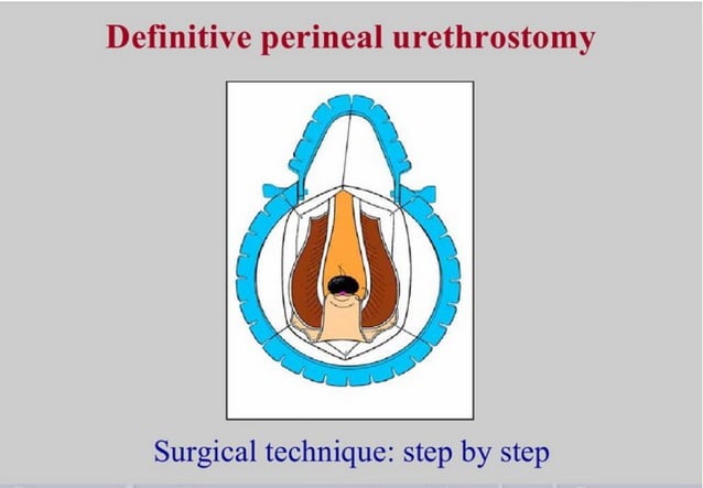 Perineal Urethrostomy perineal-urethrostomy