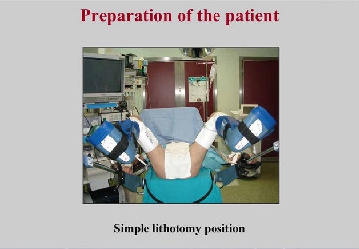 Perineal Urethrostomy perineal-urethrostomy