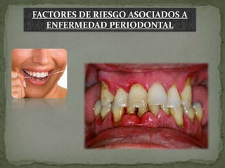FACTORES DE RIESGO ASOCIADOS A
   ENFERMEDAD PERIODONTAL
 