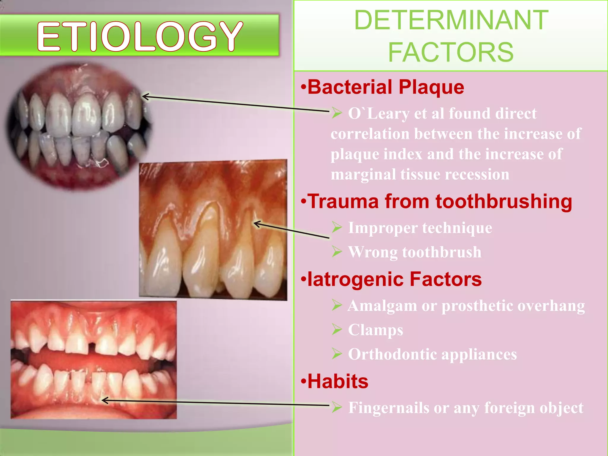 DETERMINANT
FACTORS
•Bacterial Plaque
O`Leary et al found direct
correlation between the increase of
plaque index and the increase of
marginal tissue recession
•Trauma from toothbrushing
Improper technique
Wrong toothbrush
•Iatrogenic Factors
Amalgam or prosthetic overhang
Clamps
Orthodontic appliances
•Habits
Fingernails or any foreign object