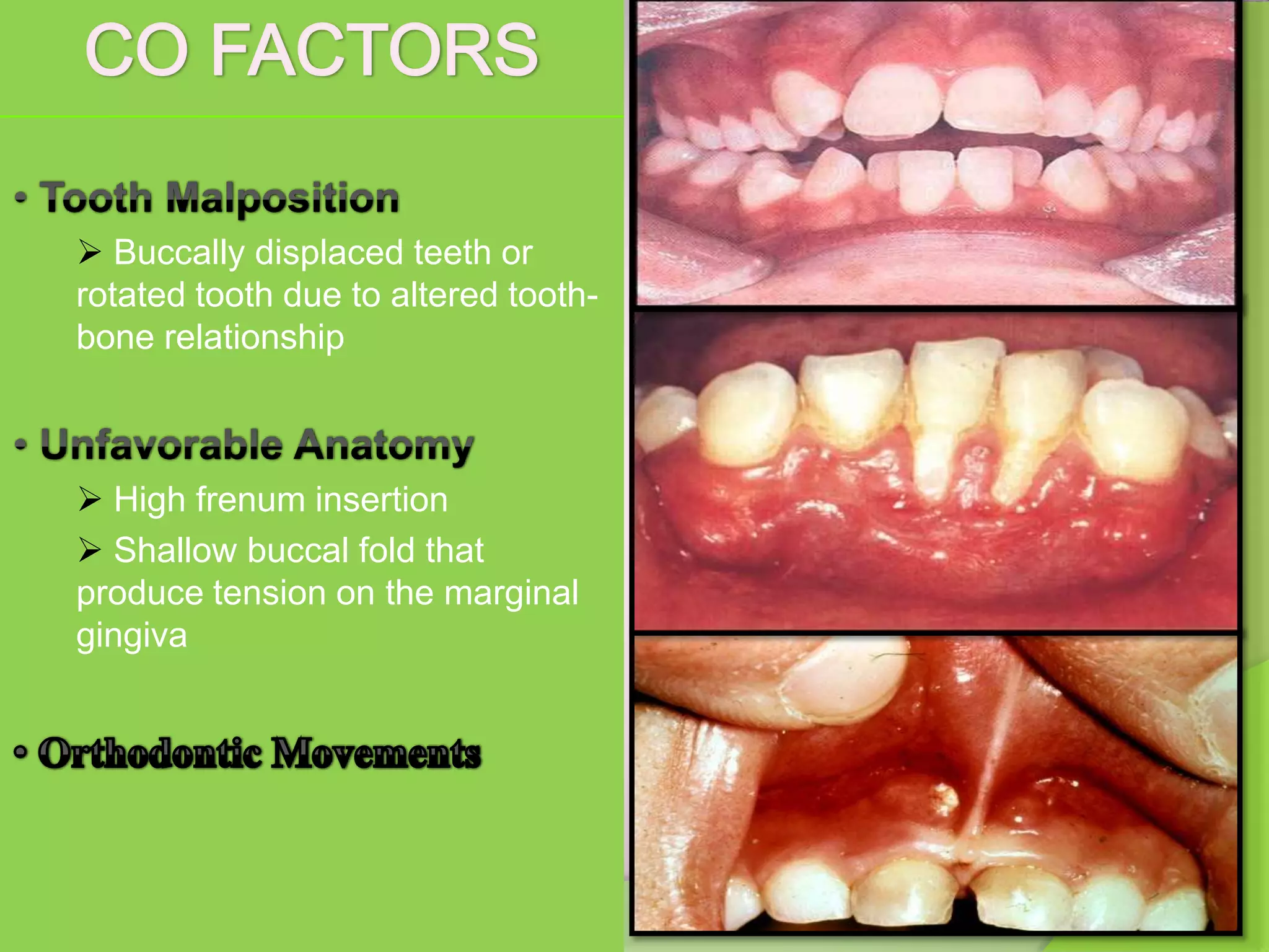  Buccally displaced teeth or
rotated tooth due to altered tooth-
bone relationship
High frenum insertion
Shallow buccal fold that
produce tension on the marginal
gingiva