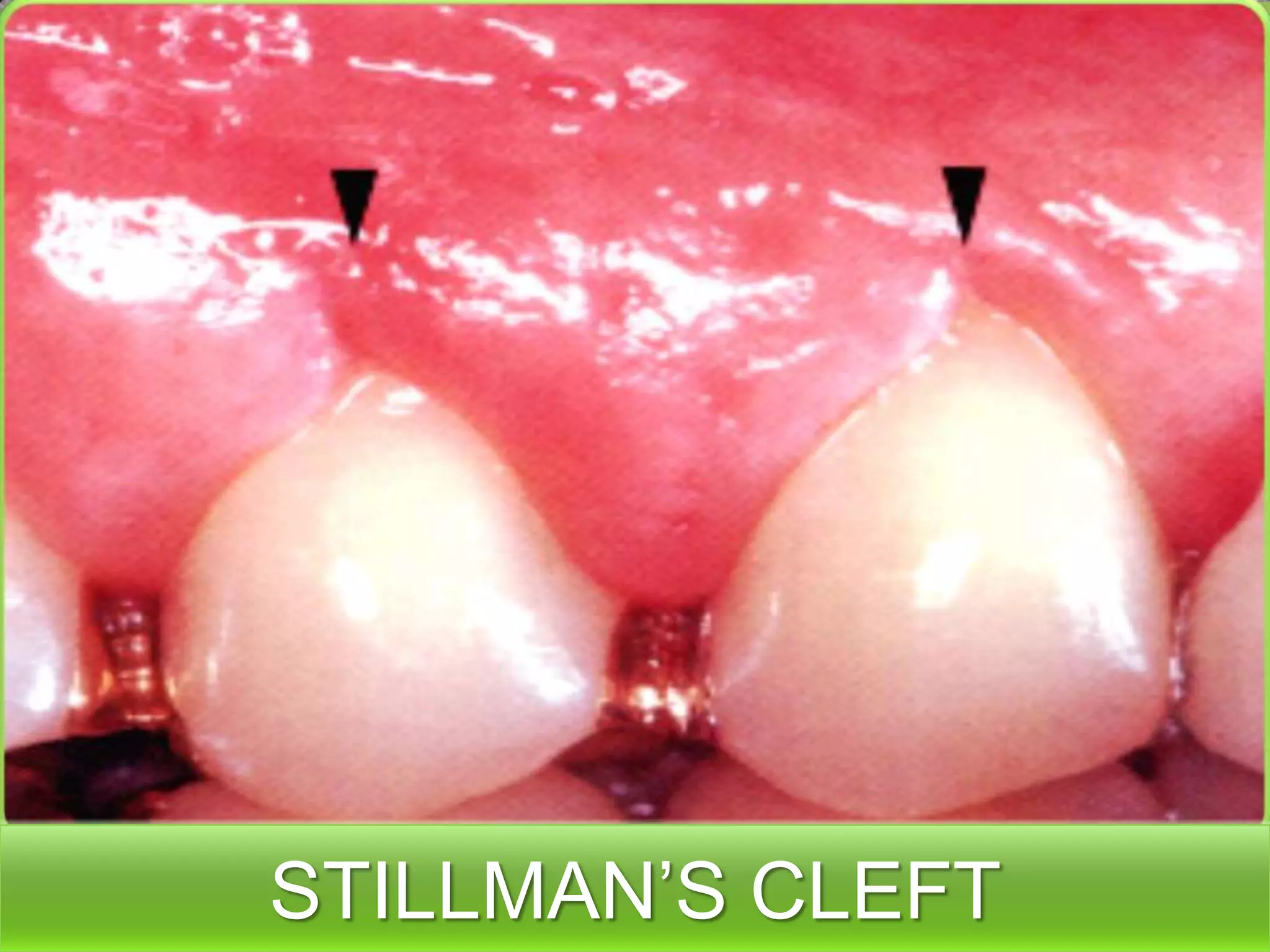 STILLMAN’S CLEFT