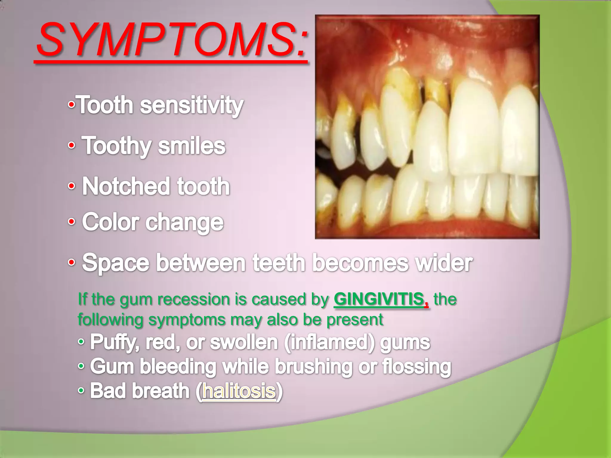 SYMPTOMS:
If the gum recession is caused by GINGIVITIS, the
following symptoms may also be present