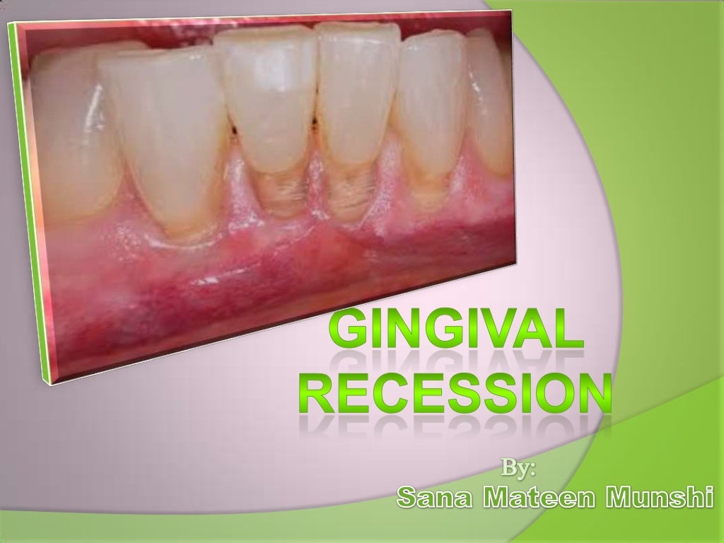 Gingival Recession
