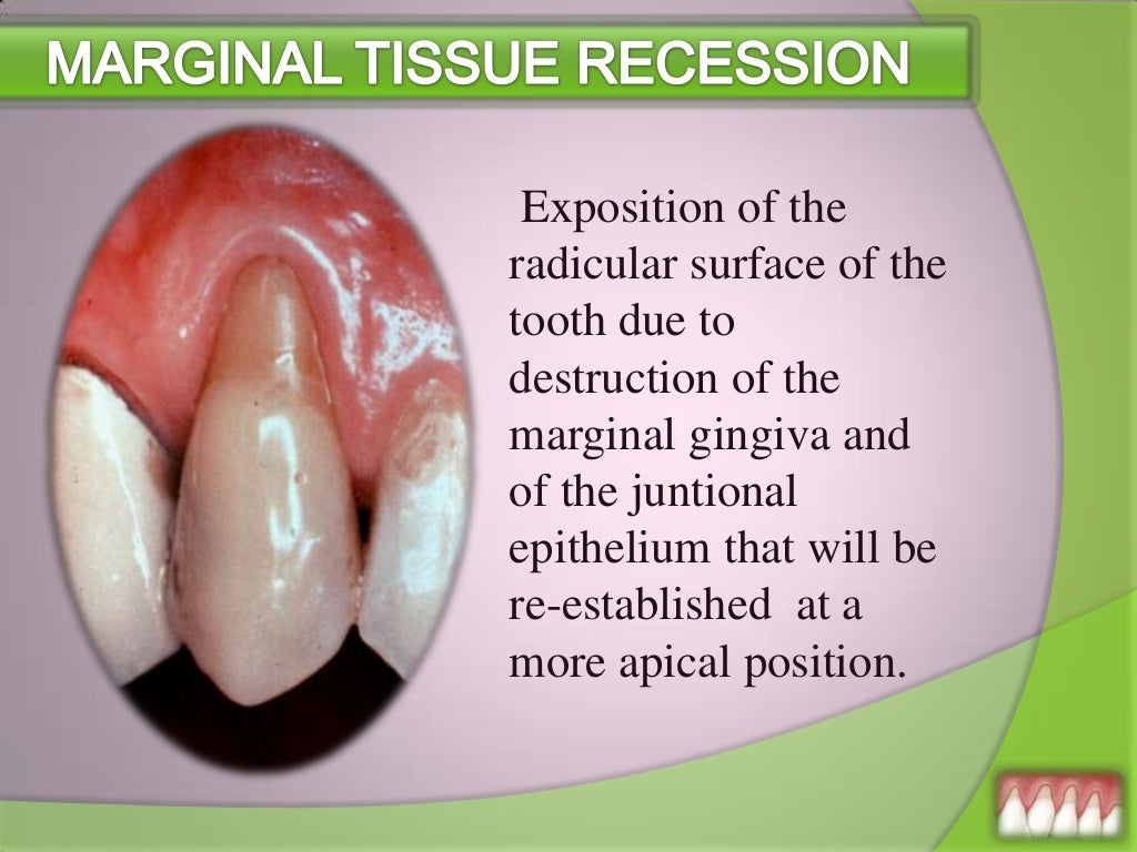 Gingival Recession