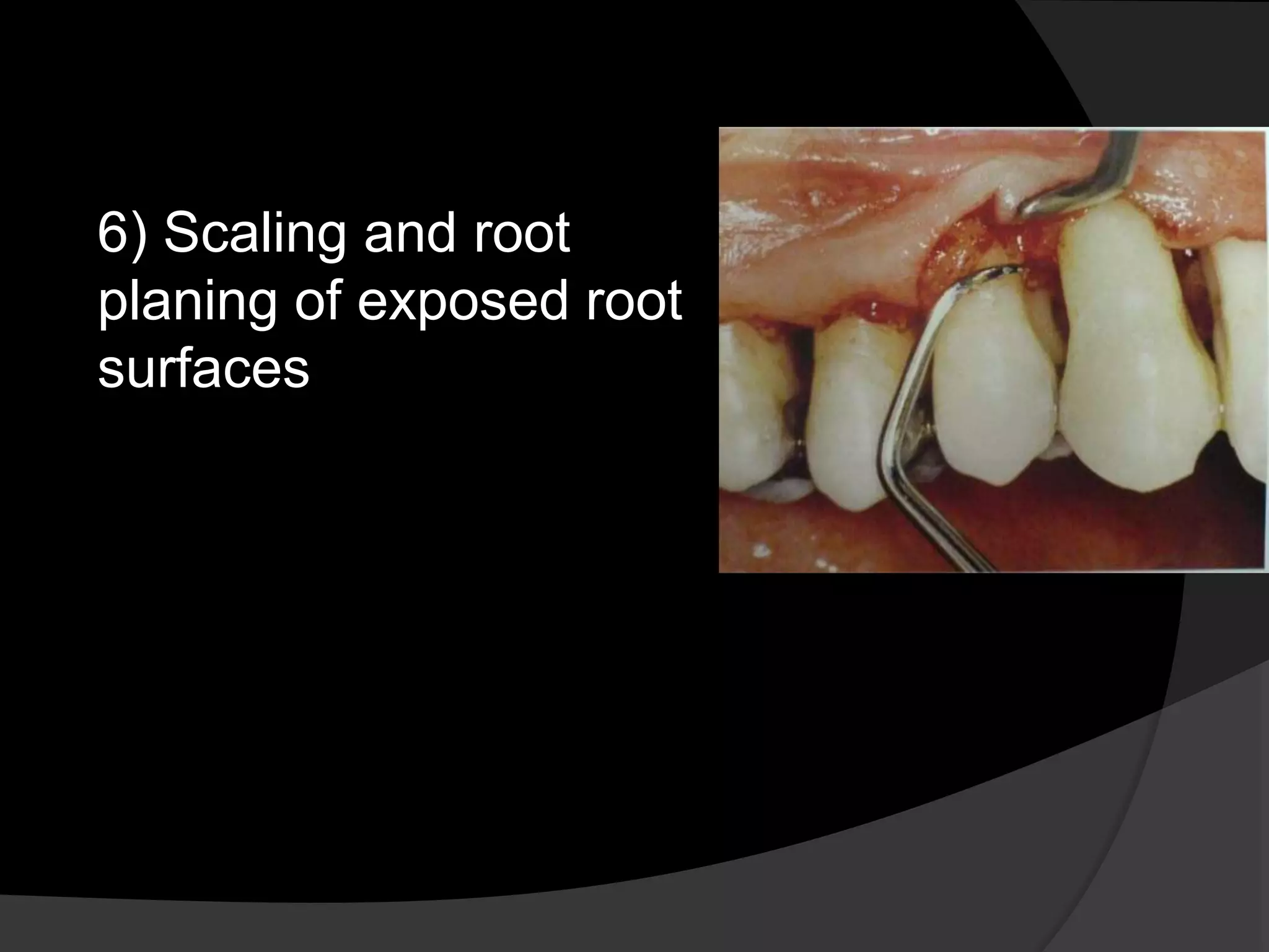 6) Scaling and root 
planing of exposed root 
surfaces 
 