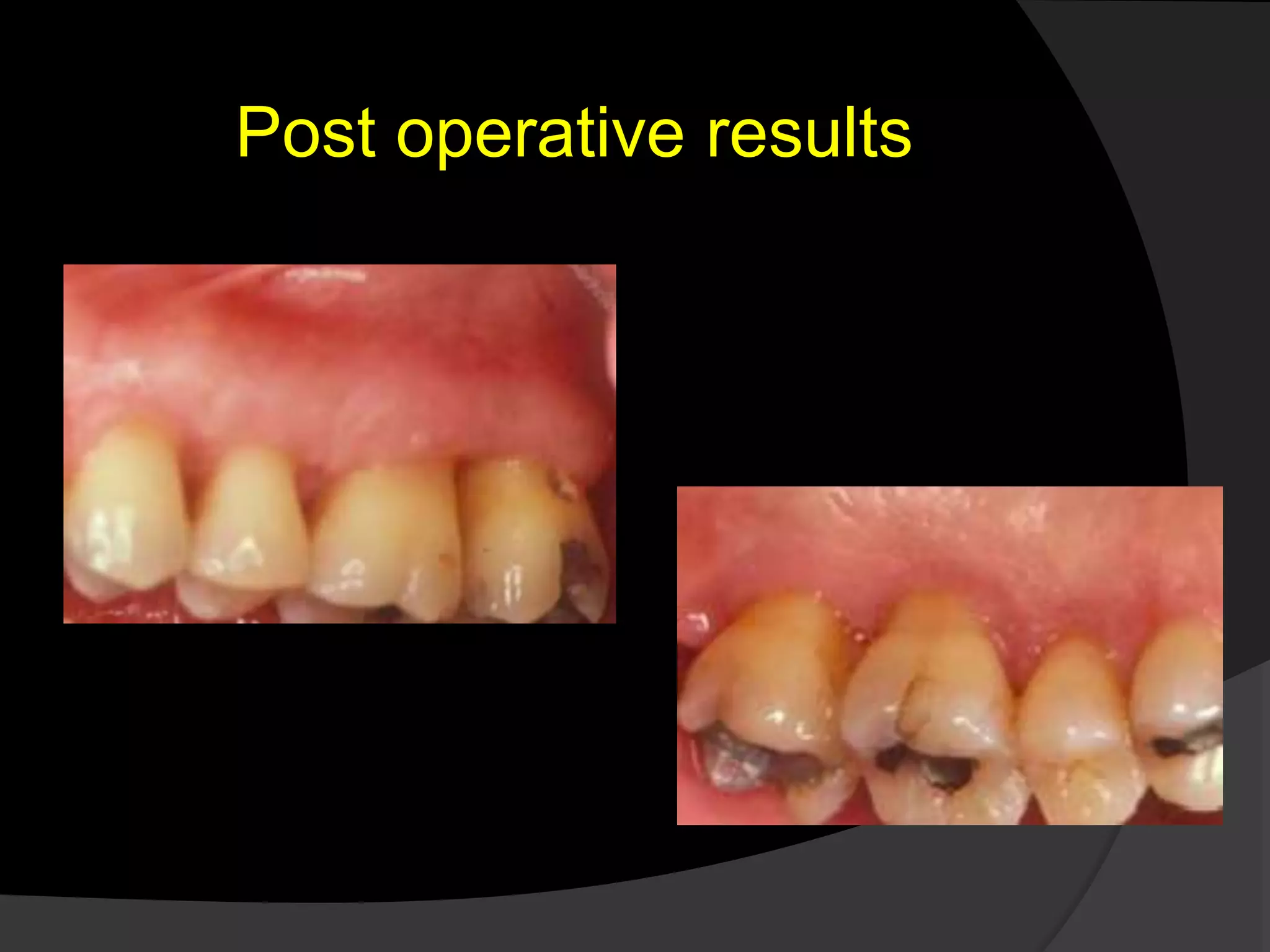 Post operative results 
 