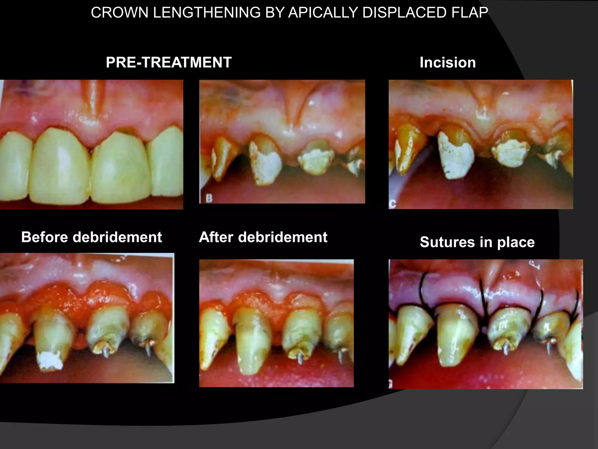 CROWN LENGTHENING BY APICALLY DISPLACED FLAP 
PRE-TREATMENT 
Before debridement After debridement 
Incision 
Sutures in place 
 