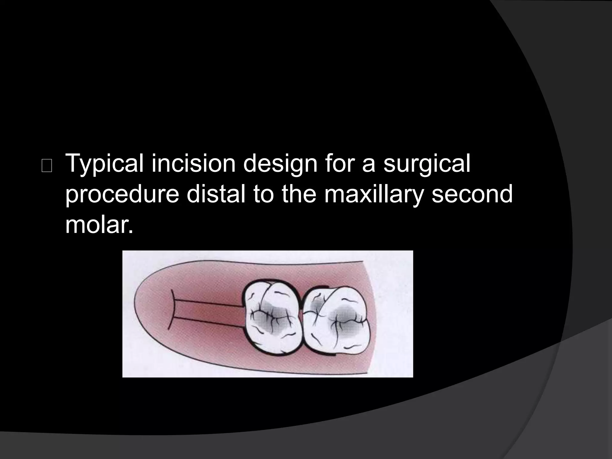 Typical incision design for a surgical 
procedure distal to the maxillary second 
molar. 
 