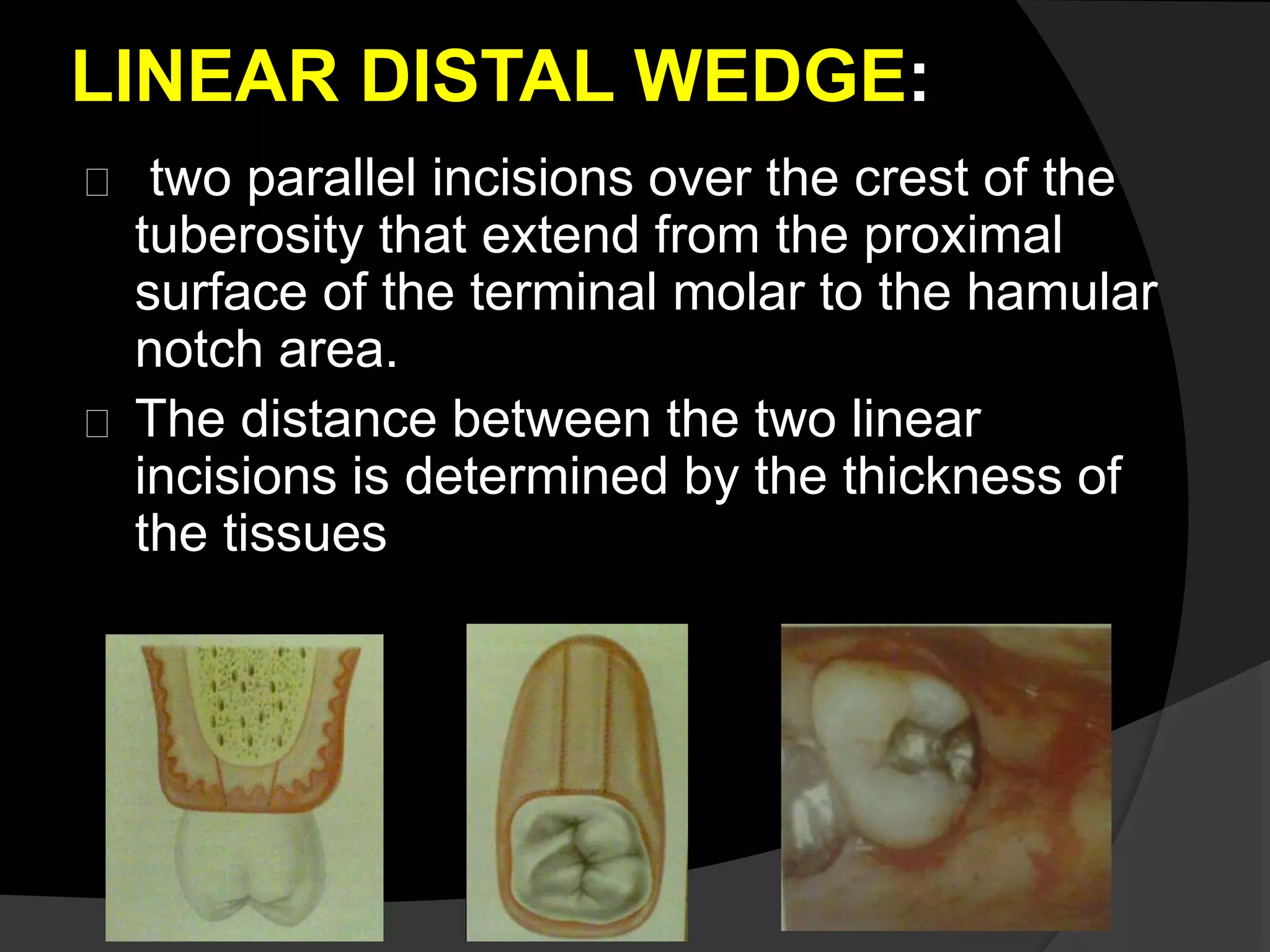 LINEAR DISTAL WEDGE: 
two parallel incisions over the crest of the 
tuberosity that extend from the proximal 
surface of the terminal molar to the hamular 
notch area. 
The distance between the two linear 
incisions is determined by the thickness of 
the tissues 
 