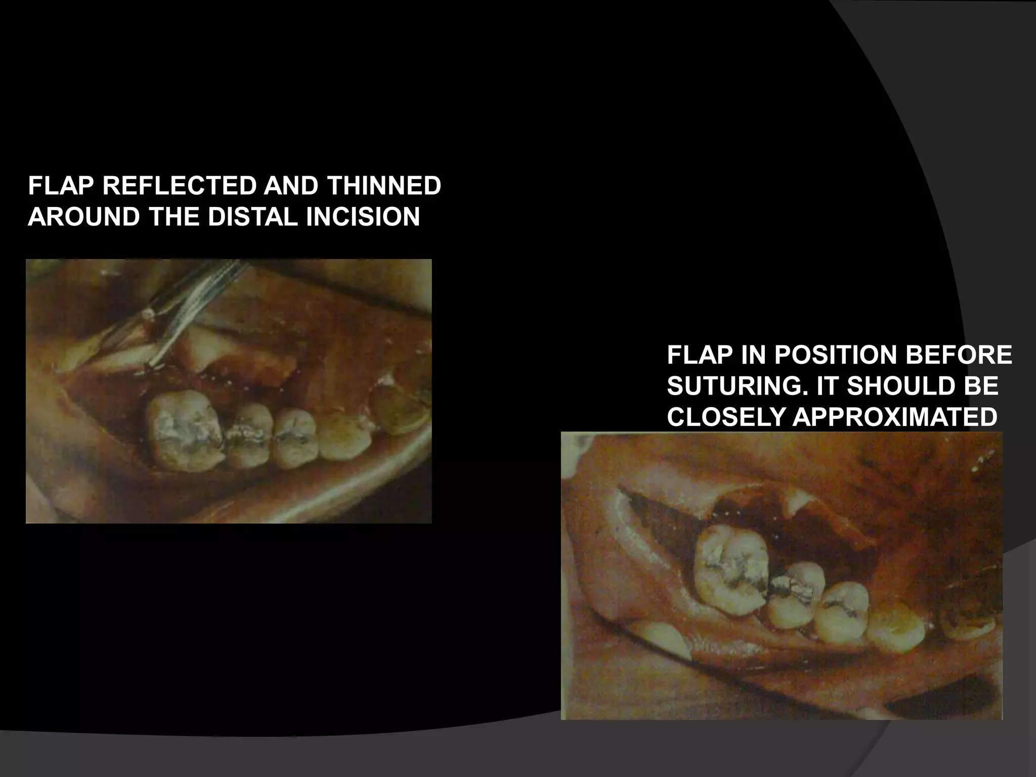 FLAP REFLECTED AND THINNED 
AROUND THE DISTAL INCISION 
FLAP IN POSITION BEFORE 
SUTURING. IT SHOULD BE 
CLOSELY APPROXIMATED 
 