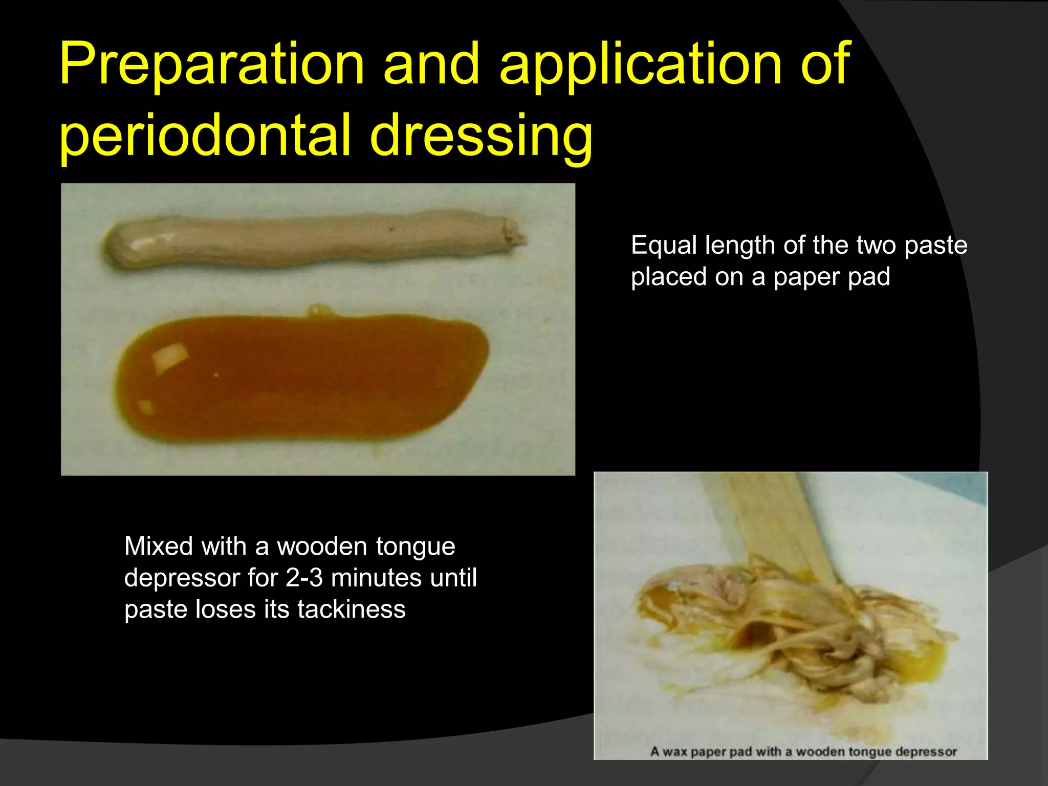 Preparation and application of 
periodontal dressing 
Equal length of the two paste 
placed on a paper pad 
Mixed with a wooden tongue 
depressor for 2-3 minutes until 
paste loses its tackiness 
 