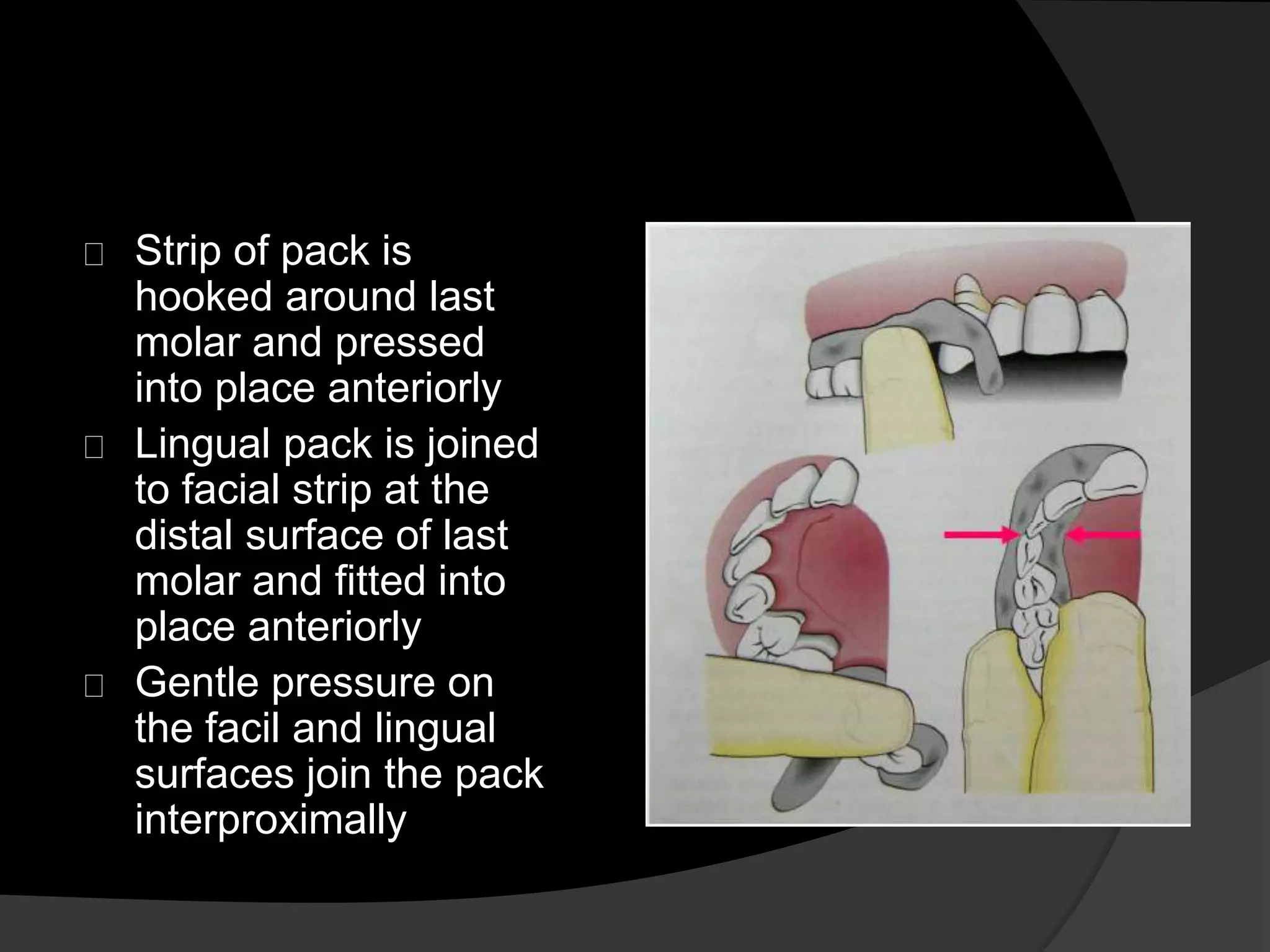 Strip of pack is 
hooked around last 
molar and pressed 
into place anteriorly 
Lingual pack is joined 
to facial strip at the 
distal surface of last 
molar and fitted into 
place anteriorly 
Gentle pressure on 
the facil and lingual 
surfaces join the pack 
interproximally 
 