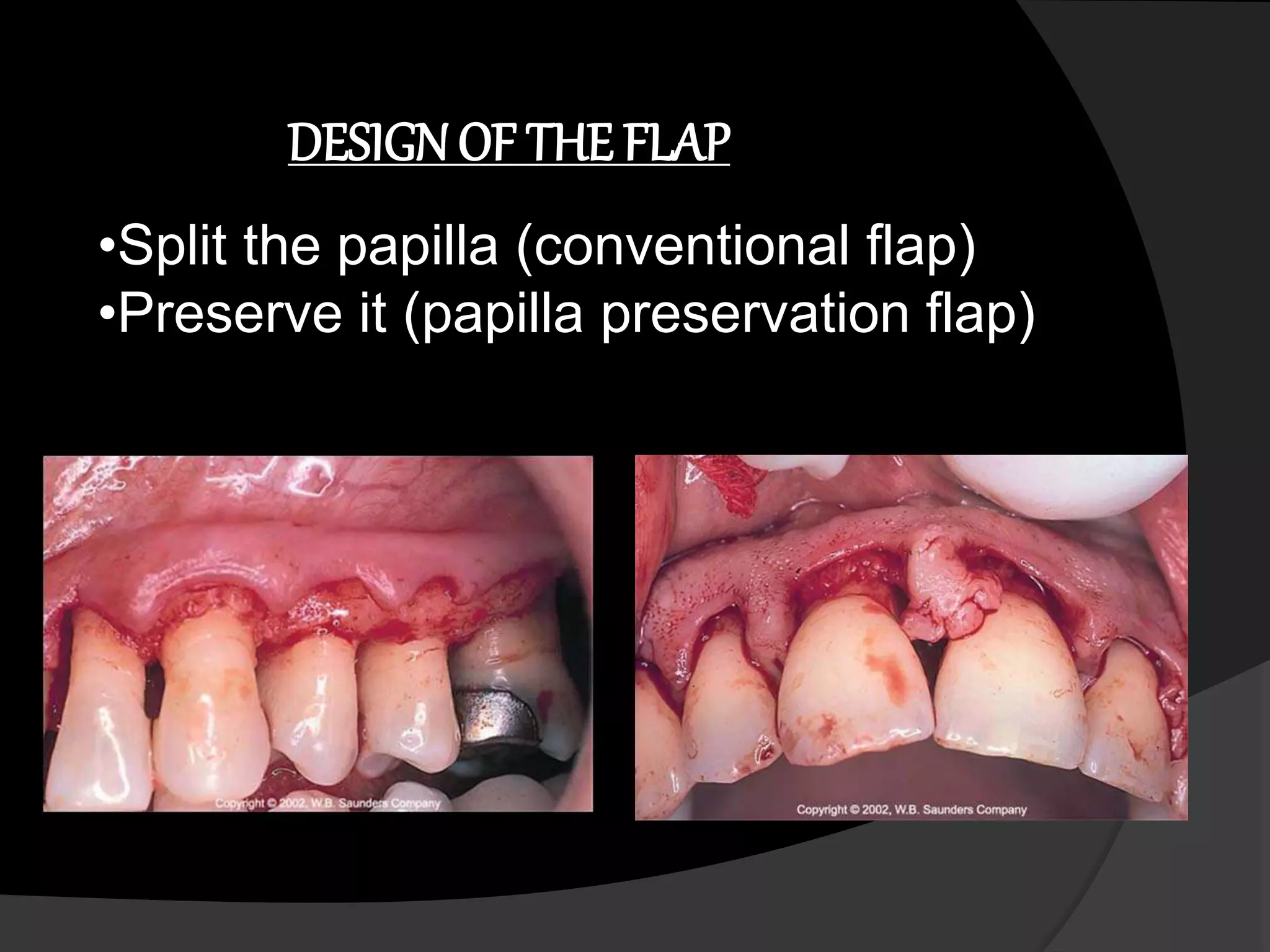 DESIGN OF THE FLAP 
•Split the papilla (conventional flap) 
•Preserve it (papilla preservation flap) 
 