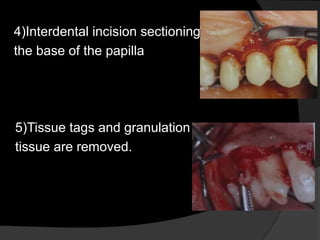 4)Interdental incision sectioning 
the base of the papilla 
5)Tissue tags and granulation 
tissue are removed. 
 