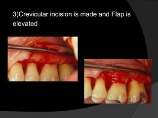 3)Crevicular incision is made and Flap is 
elevated 
 
