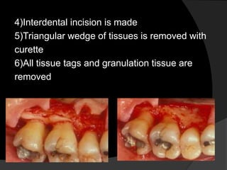 4)Interdental incision is made 
5)Triangular wedge of tissues is removed with 
curette 
6)All tissue tags and granulation tissue are 
removed 
 