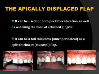 It can be used for both pocket eradication as well 
as widening the zone of attached gingiva. 
It can be a full thickness (mucoperiosteal) or a 
split thickness (mucosal) flap. 
 