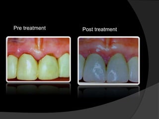 Pre treatment Post treatment 
 