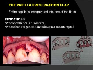 Entire papilla is incorporated into one of the flaps. 
INDICATIONS: 
•Where esthetics is of concern. 
•Where bone regeneration techniques are attempted 
 
