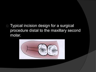 Typical incision design for a surgical 
procedure distal to the maxillary second 
molar. 
 