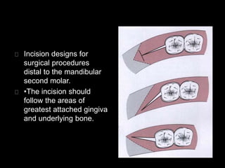Incision designs for 
surgical procedures 
distal to the mandibular 
second molar. 
•The incision should 
follow the areas of 
greatest attached gingiva 
and underlying bone. 
 
