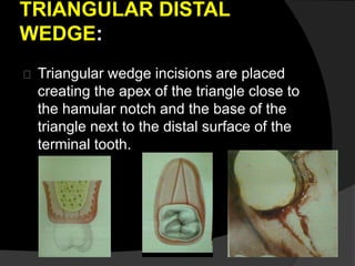 TRIANGULAR DISTAL 
WEDGE: 
Triangular wedge incisions are placed 
creating the apex of the triangle close to 
the hamular notch and the base of the 
triangle next to the distal surface of the 
terminal tooth. 
 