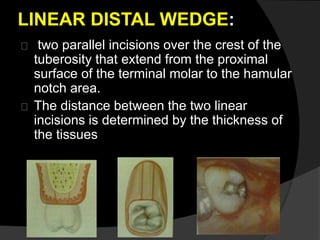 LINEAR DISTAL WEDGE: 
two parallel incisions over the crest of the 
tuberosity that extend from the proximal 
surface of the terminal molar to the hamular 
notch area. 
The distance between the two linear 
incisions is determined by the thickness of 
the tissues 
 