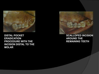 DISTAL POCKET 
ERADICATION 
PROCEDURE WITH THE 
INCISION DISTAL TO THE 
MOLAR 
SCALLOPED INCISION 
AROUND THE 
REMAINING TEETH 
 
