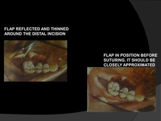 FLAP REFLECTED AND THINNED 
AROUND THE DISTAL INCISION 
FLAP IN POSITION BEFORE 
SUTURING. IT SHOULD BE 
CLOSELY APPROXIMATED 
 