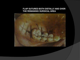 FLAP SUTURED BOTH DISTALLY AND OVER 
THE REMAINING SURGICAL AREA 
 