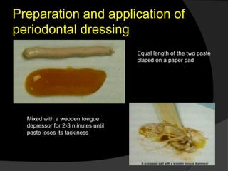 Preparation and application of 
periodontal dressing 
Equal length of the two paste 
placed on a paper pad 
Mixed with a wooden tongue 
depressor for 2-3 minutes until 
paste loses its tackiness 
 