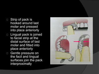 Strip of pack is 
hooked around last 
molar and pressed 
into place anteriorly 
Lingual pack is joined 
to facial strip at the 
distal surface of last 
molar and fitted into 
place anteriorly 
Gentle pressure on 
the facil and lingual 
surfaces join the pack 
interproximally 
 