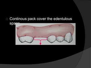 Continous pack cover the edentulous 
space 
 