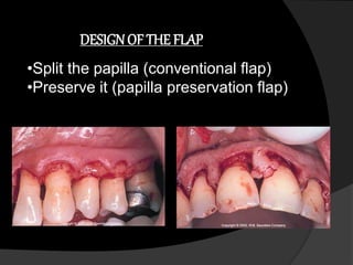 DESIGN OF THE FLAP 
•Split the papilla (conventional flap) 
•Preserve it (papilla preservation flap) 
 