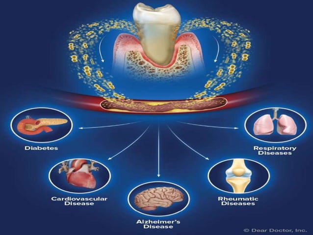 Periodontitis as a manifestation of systemic diseases | PPT