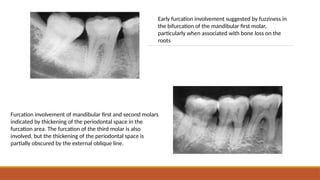 RADIOGRAPHIC AIDS IN DIAGNOSIS OF PERIODONTAL DISEASE | PPTX