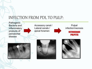 INFECTION FROM PDL TO PULP:
Pathogenic
Bacteria and
inflammatory
products of
periodontal
disease
Accessory canal /
Lateral canals /
apical foramen
Pulpal
infection/necrosis
RETROGRADE
PULPITIS
 