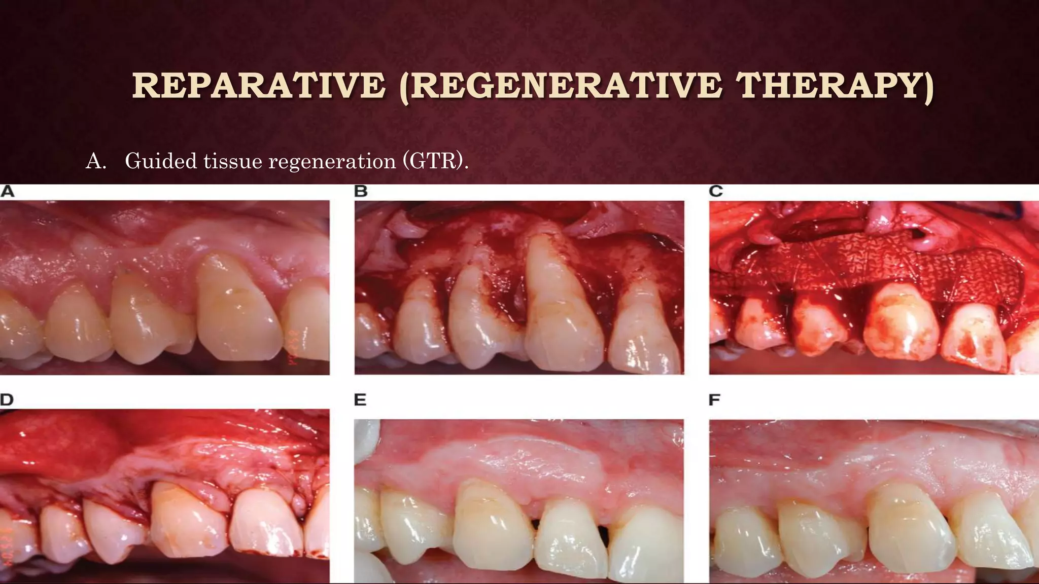 EndoPerio Lesions PPT