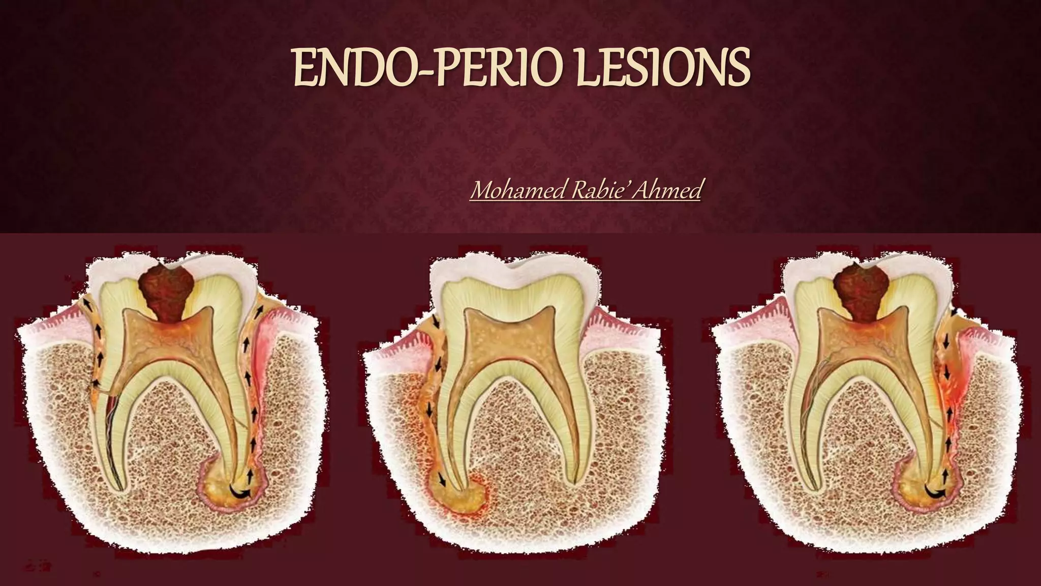 EndoPerio Lesions Diagnosis and Treatment PPT