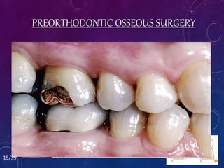 OSSEOUS CRATERS
• Interproximal, two-wall defect that does not improve with
orthodontic treatment.
• Some shallow craters (4- to 5-mm pocket) may be
maintainable nonsurgically during orthodontic treatment.
• If surgical correction is needed this type of osseous lesion
can be eliminated by reshaping the defect & ↓ PD.
• This in turn enhances the ability to maintain these
interproximal areas during orthodontic treatment.
PREORTHODONTIC OSSEOUS SURGERY
15/39
 