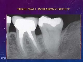 • Three-wall defects are amenable to pocket
reduction with regenerative periodontal
therapy.
• Bone grafts using either autogenous bone
or allografts along with the use of
resorbable membranes have been
successful in filling three-wall defects.
• If the result of periodontal therapy is stable
3 to 6 months after periodontal surgery ,
orthodontic treatment may be initiated.
THREE WALL INTRABONY DEFECT
16/39
 