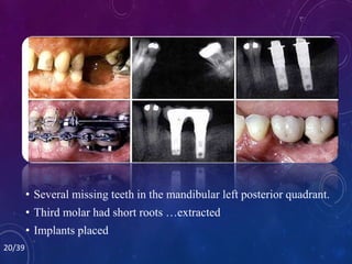 • Several missing teeth in the mandibular left posterior quadrant.
• Third molar had short roots …extracted
• Implants placed
20/39
 