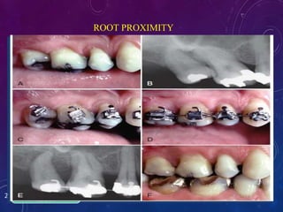 ROOT PROXIMITY
Roots of posterior teeth in close proximity
Compromised periodontal health
Compromised accessibility for restoration of adjacent
teeth.
21/39
Orthodontic
therapy
Roots can be
moved apart
Bone will be
formed b/w the
adjacent roots
Opens
Embrasure
beneath the
tooth contact
Additional
bone support
Enhances pt's
access to
interproximal
region.
Improves the
periodontal
health of this
area.
 