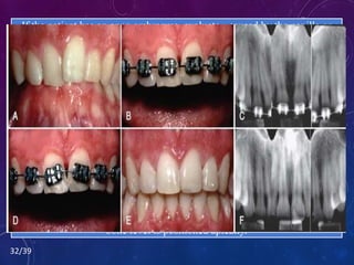32/39
Another possibility is to erupt adjacent teeth when the interproximal
bone level is positioned apically.
This type of movement may help create a more esthetic papilla between
two teeth despite alveolar bone loss.
By closing open contacts, the interproximal gingiva can be squeezed and
moved incisally.
In some situations, a deficient papilla can be improved with orthodontic
treatment.
Papilla is the problem, the cause is lack of bone support due to an
underlying periodontal problem.
If the patient has an open embrasure, evaluate - caused by the papilla or
the tooth contact.
 