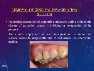 REMOVAL OF GINGIVAL INVAGINATION
(CLEFTS)
• Incomplete adaptation of supporting structures during orthodontic
closure of extraction spaces - infolding or invagination of the
gingiva.
• The clinical appearance of such invagination : a minor one
surface crease to deep clefts that extend across the interdental
papilla.
34/39
 