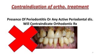 24
Presence Of Periodontitis Or Any Active Periodontal dis.
Will Contraindicate Orthodontic Rx
 