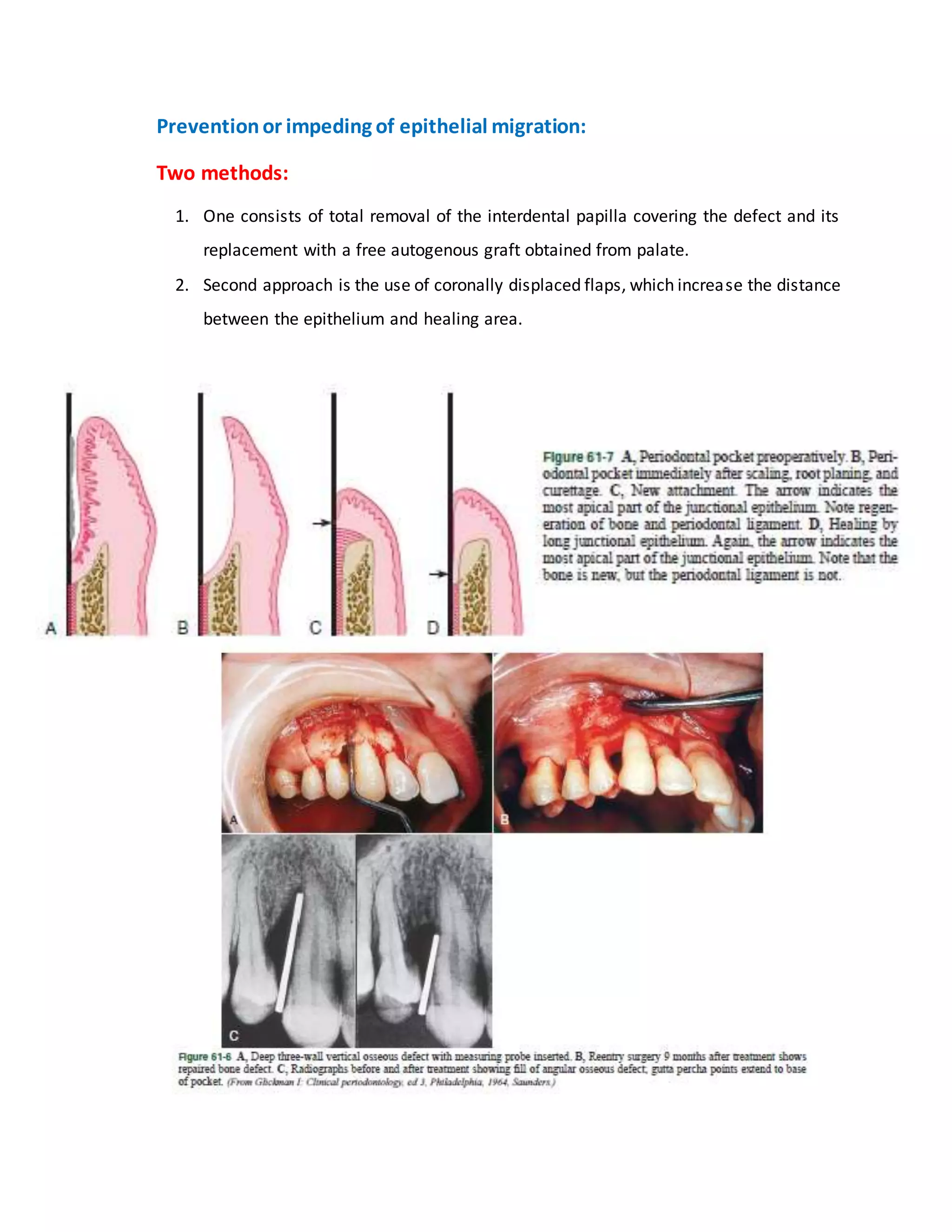 “Preventionor impeding of epithelial migration:”
“Two methods:
1. One consists of total removal of the interdental papilla covering the defect and its
replacement with a free autogenous graft obtained from palate.
2. Second approach is the use of coronally displaced flaps, which increase the distance
between the epithelium and healing area.””
 