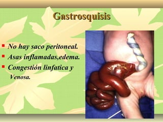 GastrosquisisGastrosquisis
 No hay saco peritoneal.
 Asas inflamadas,edema.
 Congestión linfatica y
Venosa.
 
