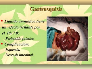 GastrosquisisGastrosquisis
 Líquido amniotico tiene
un efecto irritante por
el Ph 7.0:
Peritonitis química.
 Complicación:
Isquemia.
Necrosis intestinal.
 